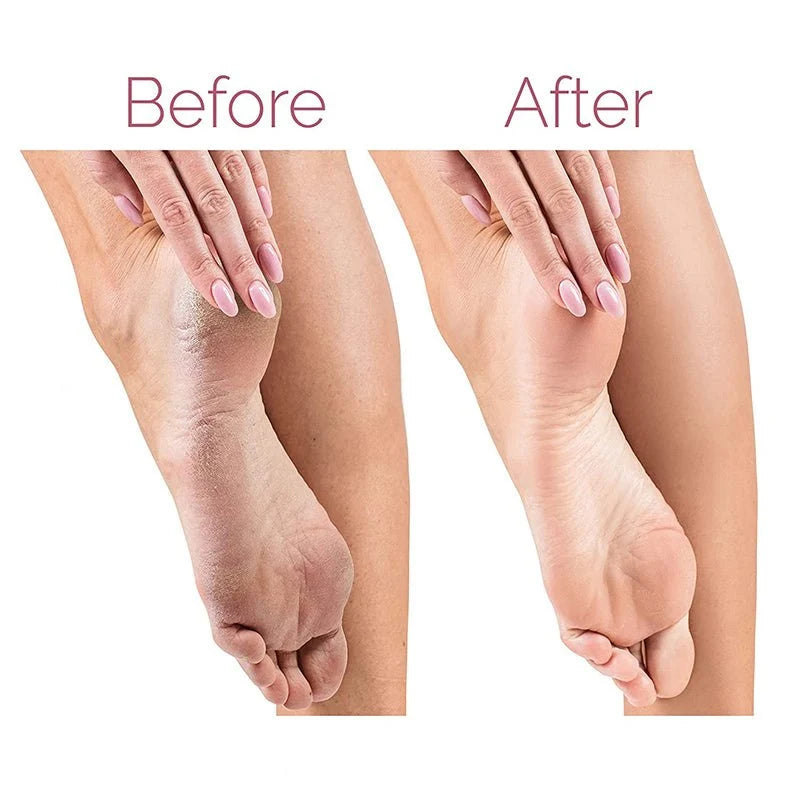 Electric Callus Remover for Feet – Portable Hard Skin & Dead Skin Remover Pedicure Tool