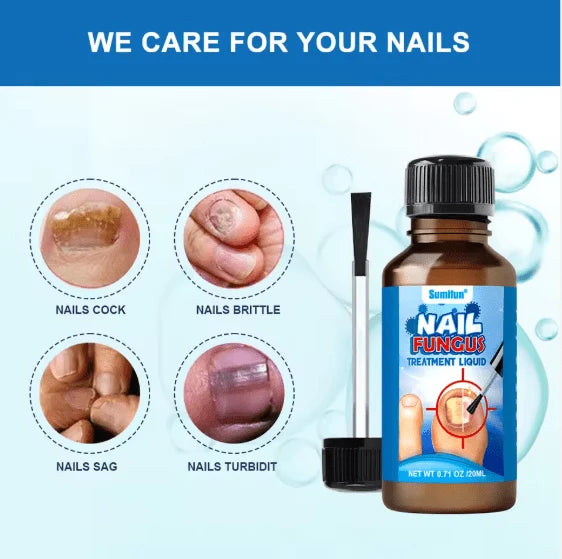 Sumifun Nail Fungus Treatment Liquid (20ml) – Antifungal Broken & Discolored Nail Repair Solution